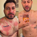 Ex-BBB Caio Afiune assusta fãs após reação alérgica intensa e ida ao hospital
