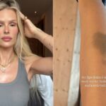 Yasmin Brunet exibe hematoma na perna e fala sobre convivência com lipedema